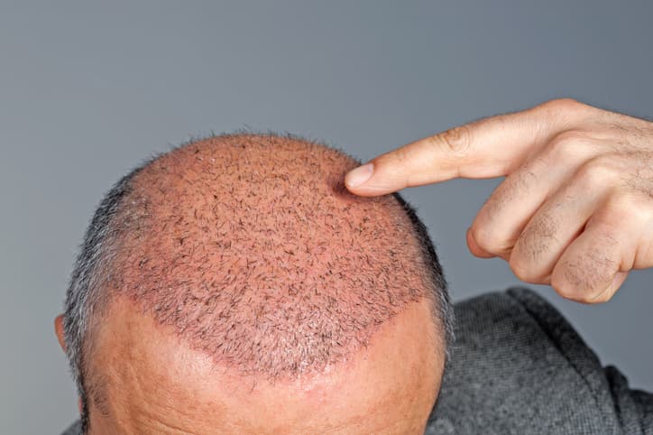 Medizinische Haarausfall-Behandlung und Kopfhaut-Diagnostik bei Derm4hair